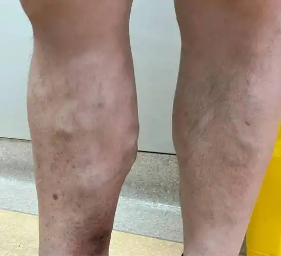 嘉兴二院下肢肿胀门诊开诊,一站式解决