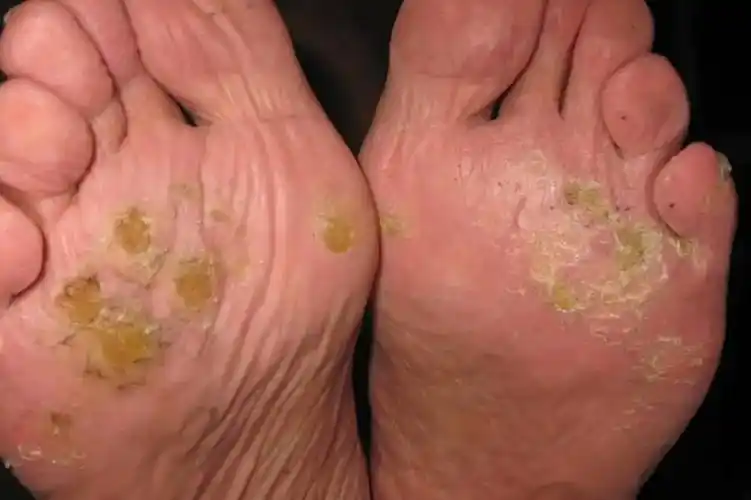 点滴状掌跖角化病