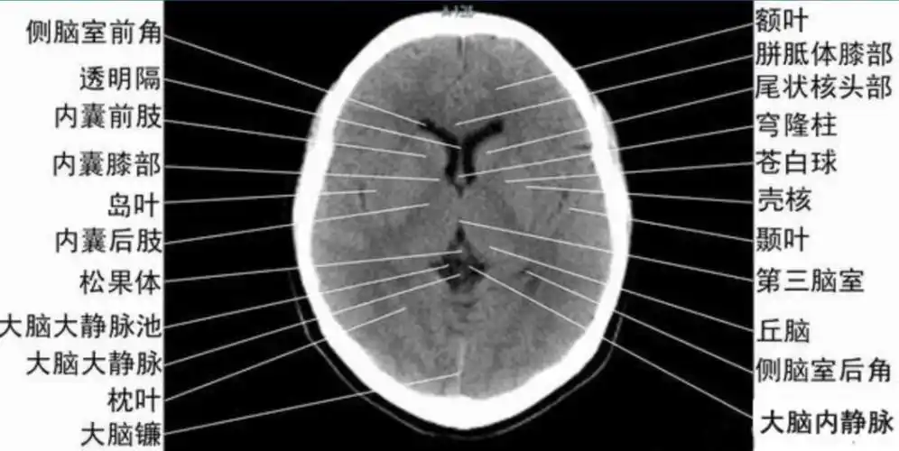 读懂头颅ct并不难教你成为读片小能手