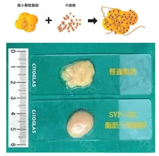 自体脂肪填充广受求美者的喜爱,但是脂肪移植和脂肪胶移植存在着一些