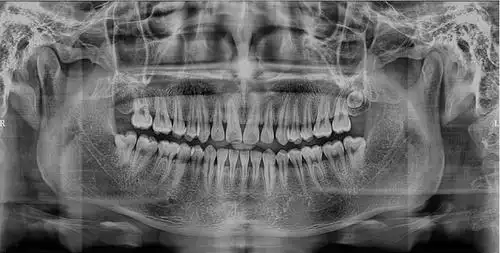 牙医520重磅发布这台有ai的口腔cbct来了