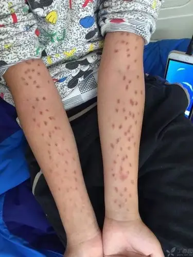 看图识病如此密集对称的双上肢瘀斑难不成是自残