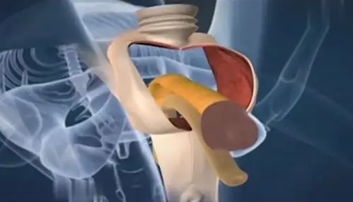 神科普!男变女变性手术全程-健康视频-搜狐视频