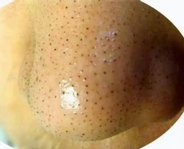 怎样去除顽固黑头粉刺?