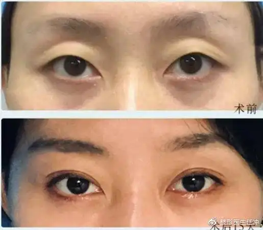 眼窝凹陷填充效果对比