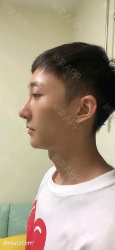 像我这种情况可以用鼻基底硅胶假体,或者玻尿酸填充都可以