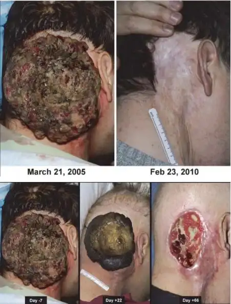 晚期肿瘤癌症新疗法肿瘤浸润淋巴细胞til疗法临床试验进行中有望上市