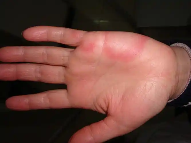 反复手足出现红斑10余年 - 皮肤及性传播疾病讨论版 - 爱爱医医学论坛