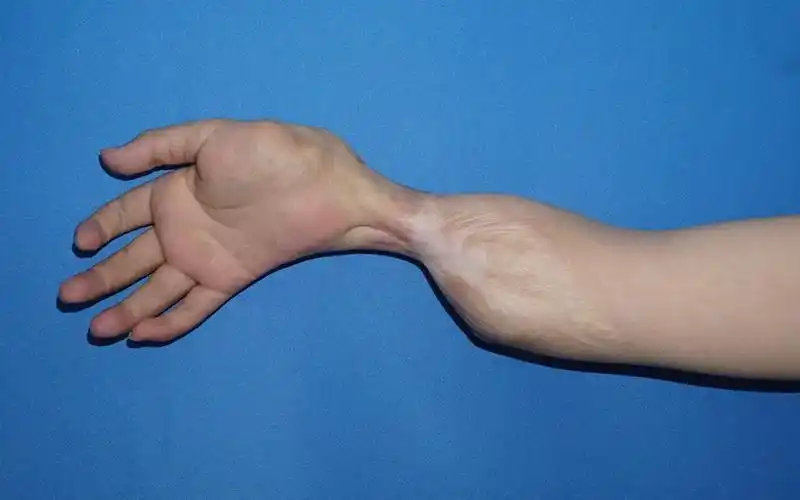 腕关节严重尺偏畸形(尺拐手)的矫正—典型病例 - 好大夫在线