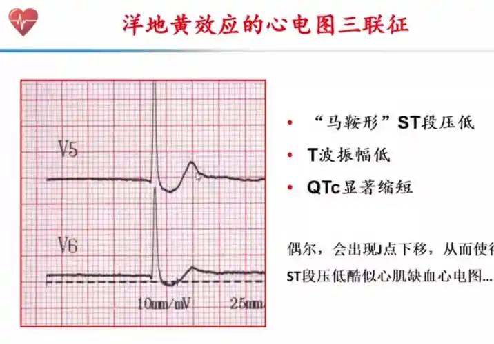 典型的洋地黄效应是在以r为主导联中(v4-v6导联)st-t呈"鱼钩样"改变