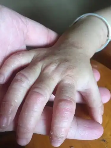 小孩的手又痒又掉皮怎么回事用了很多药膏都不行