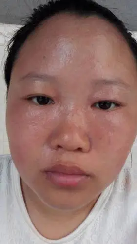 怀孕36周 长湿疹了!昨天拿了洗的药和擦的!今天手上像长泡一样!