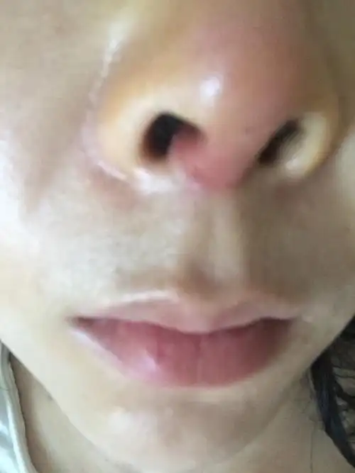 l型硅胶隆鼻后第三天左鼻孔内长红包包,鼻小柱红肿痛,今天第五天
