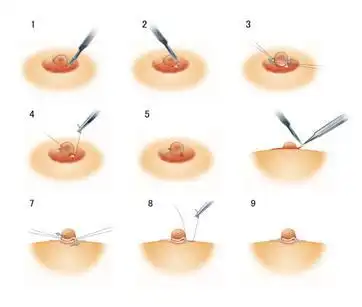 乳头凹陷整形多少钱?