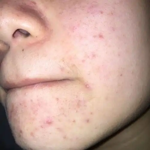 为什么脸上 会突然狂长痘痘?