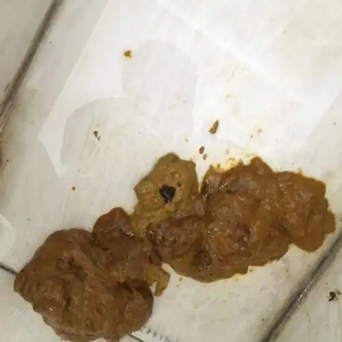 这种屎健康吗?里面的黑色东西是什么?很担心.