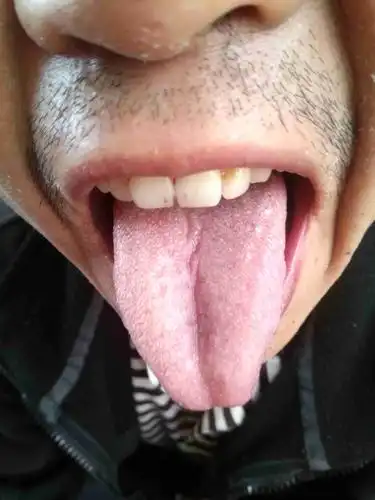 这舌苔是胃火,寒胃吗?