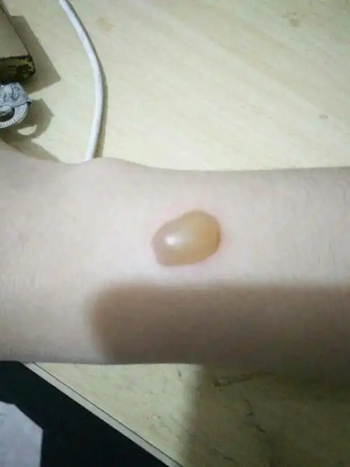 被烟烫的,已经两天,该怎样处理