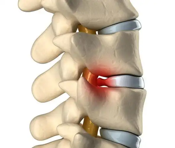 作为以退变为主因的疾病,腰椎间盘突出的发生应该是以中老年人为主