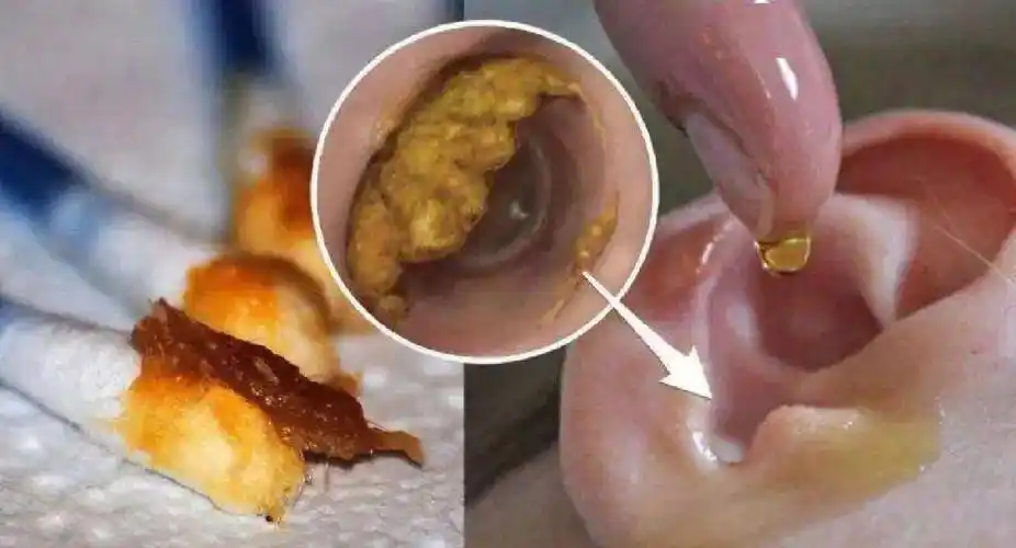 助听器  #听力损失  耵聍又称"耳屎",它是从外耳道皮肤下的耵聍腺中