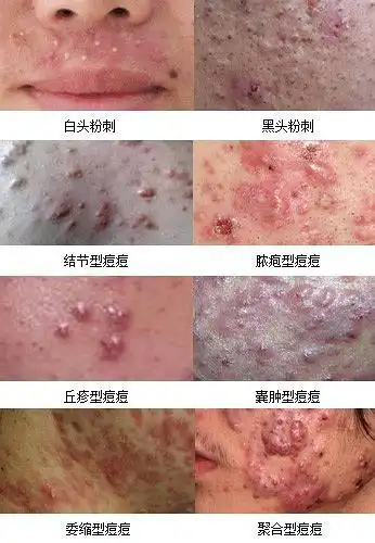 不了解自己的痘痘类型怎么祛痘?
