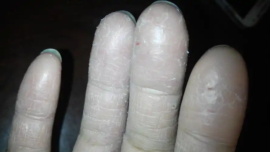 沙发回复klw200817天前皲裂湿疹,治疗: 马齿苋30g,徐长卿30g,土槿皮