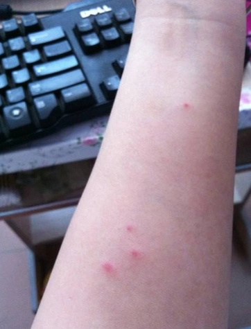 蜘蛛痣图片 (41)_有来医生