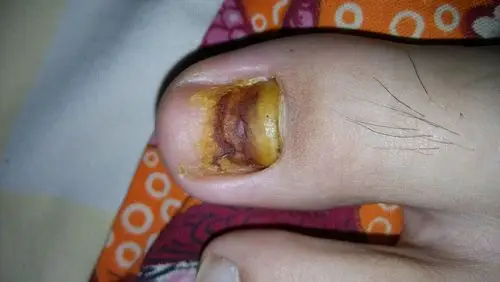 甲脱落,甲床外露,看甲床中间还有一道沟,像是压进去的.