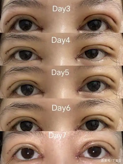 全切双眼皮第50天,恢复攻略来啦8月下半旬去做了双眼皮,本来就想今年