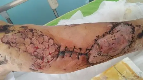 第一例植皮手术,求拍砖! [病例帖]