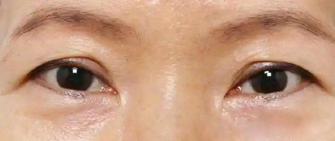 双眼皮|内眦赘皮|上睑下垂|重睑_网易订阅