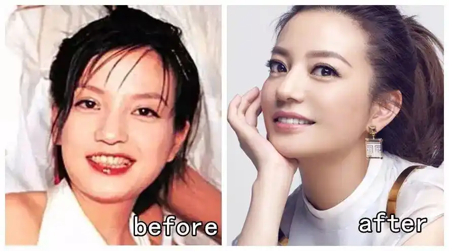 赵薇刚出道的时候,牙齿黄黄的,存在着四环素牙的问题,做了门牙的美