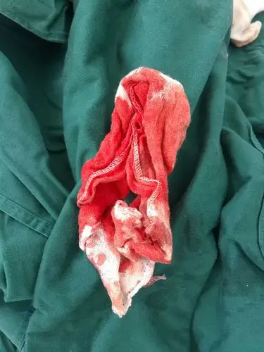 术中出血约30毫升,就一块纱布.