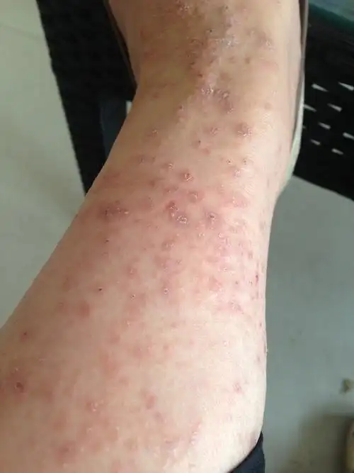 为什么孕期湿疹容易长孕妇应该如何预防湿疹