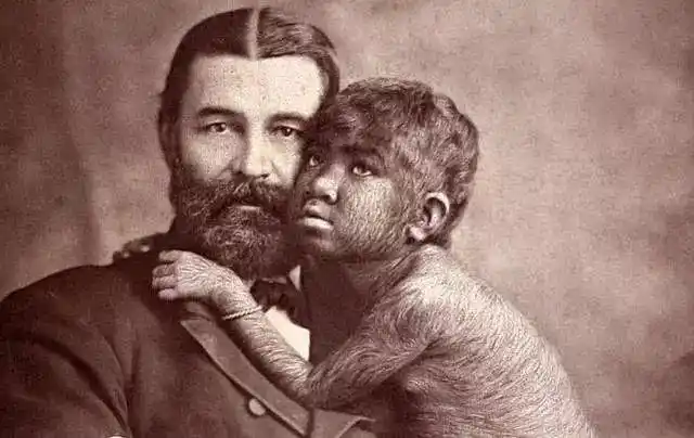 西班牙17名儿童吃了问题糖浆后患上狼人综合症