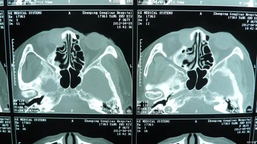 【泪器疾病讨论】早期曾被误诊的泪囊肿瘤 [病例帖]