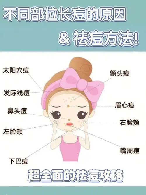 痘痘肌必看|不同部位长痘的原因和祛痘方法