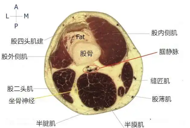 图6膝关节横断面解剖根据sinha博士的技术超声引导ipack阻滞是一个