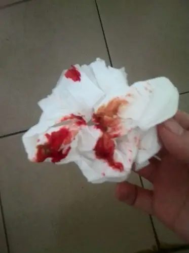 大便便血 拉鲜红色的血,不知道是什么病