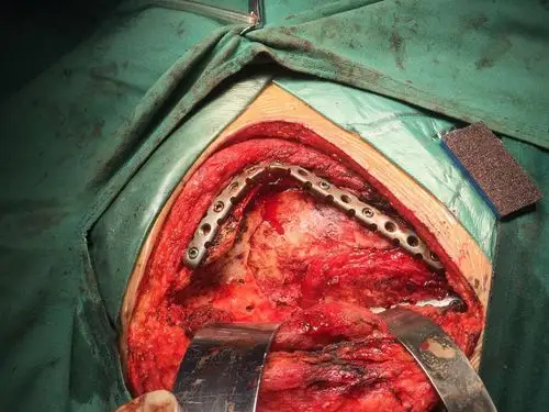 肩胛骨骨折手术治疗心得