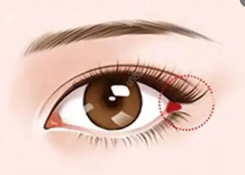 魏志香高难度眼睛修复技术好,双眼皮/外眼角修复实例分享