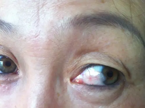 帮我看下我姐眼睛这个疾病是什么.