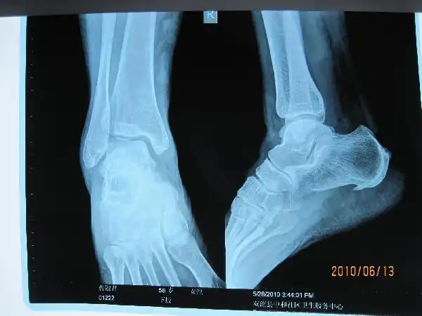 疾病真相你所不知道的骨刺的秘密