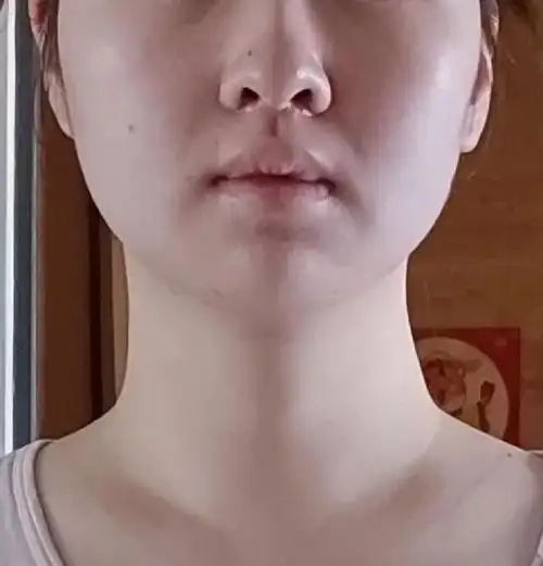 为什么拔完智齿脸凹陷啊啊啊