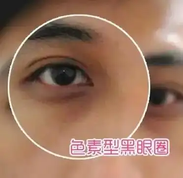 3分钟了解你的黑眼圈怎么回事