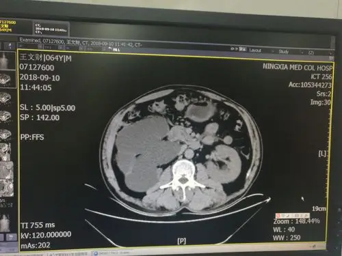 结石致重度肾积水 - 好大夫在线