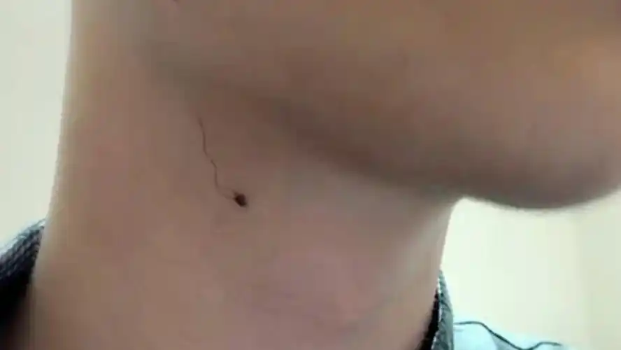 男人脖子右边长痣好不好?