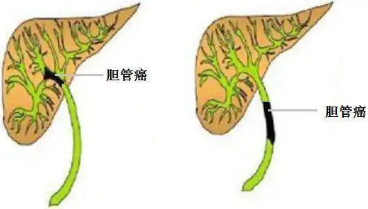胆管癌能不能用微创手术治疗广州中医药大学第一附属医院钟崇
