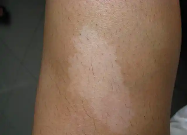 无色素痣 的表现及与白癜风和贫血痣的区别_痣_症状_症状表现 - 好