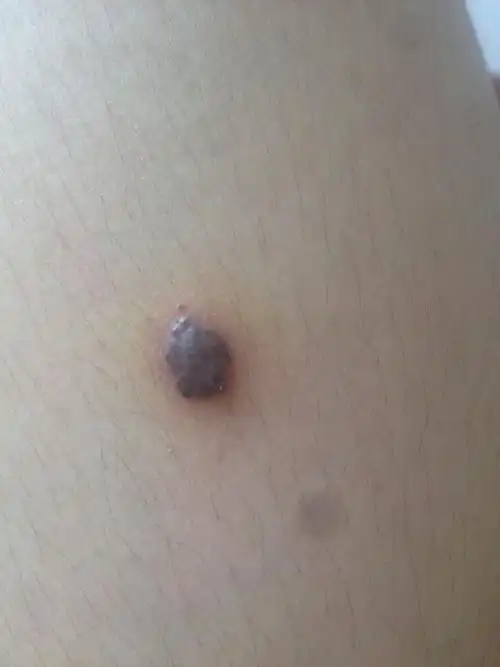 我腿上长了个黑色的疙瘩,是什么啊?